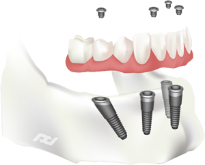 Dental Implants in Highlands Ranch, CO