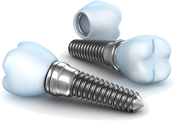 Dental Implant